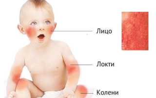 Что такое кожный дерматит и как его лечить
