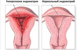 Может ли переходить в рак атипическая гиперплазия эндометрия