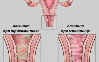 Кольпит у женщин: симптомы и лечение