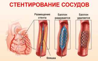 Стентирование сосудов: показания и техника проведения