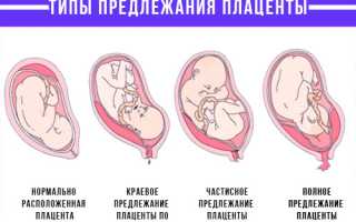 Краевое предлежание плаценты по передней и задней стенке: что это значит, чем опасно, прогнозы