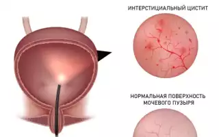 Лечение интеркуррентного цистита