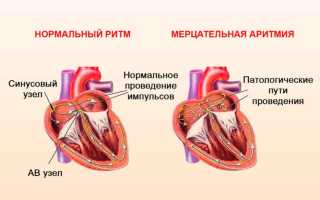 Как лечатся сердечные аритмии?
