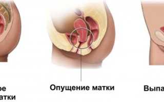 Что делать при опущении матки — операция, гимнастика, бандаж, народные средства