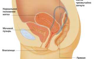 Загиб шейки матки — причины и последствия