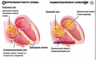 В чем различия между тахикардией и аритмией?