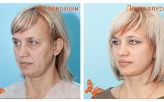 СМАС лифтинг аппаратная подтяжка лица, отзывы о процедуре
