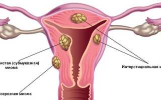 Признаки узловой миомы матки в сочетании с эндометриозом
