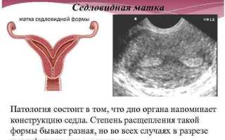 Грушевидная и седловидная форма матки