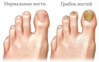 Что делать, если кожа на ногах сухая и шелушится кожа, причины