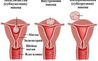 Внутренняя миома матки