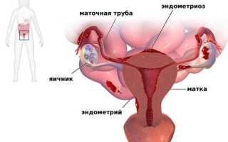 Самые эффективные свечи для лечения эндометриоза матки