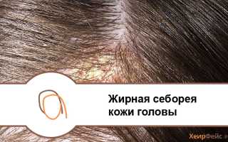 Жирная себорея кожи головы 7 ЛУЧШИХ СРЕДСТВ ЛЕЧЕНИЯ! (ФОТО)