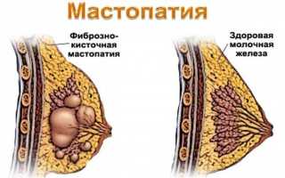 Диффузная фиброзно-кистозная мастопатия молочных желез