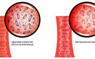 Диагностика бактериального вагиноза и его лечение