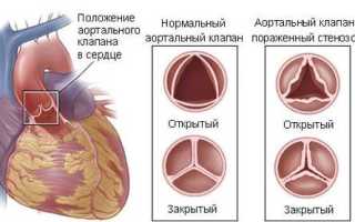 Все о пороках сердца с дефектами аортального клапана