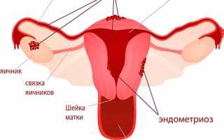 Эндометриоз тела матки — симптомы и лечение патологии