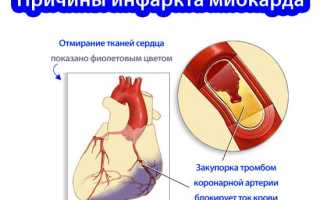 Симптомы и признаки предынфарктного состояния