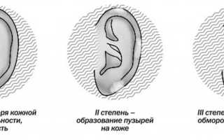 Обморожение у детей: симптомы, первая помощь, лечение