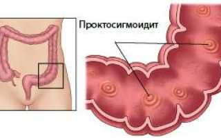 Все факты о катаральном проктосигмоидите: чем грозит, если невовремя обнаружить и не лечить?