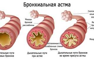 Бронхиальная астма: симптомы, лечение, неотложная помощь в домашних условиях