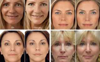 Уход после биоревитализации за кожей лица * Как правильно делать после процедуры маску, что нельзя