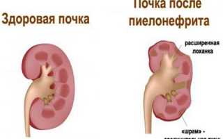 Пиелонефрит симптомы диагностика и лечение