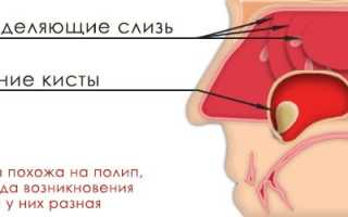 Киста околоносовой пазухи: симптоматика и опасность заболевания