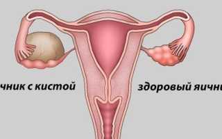 Что такое киста яичника: симптомы и лечение у женщин