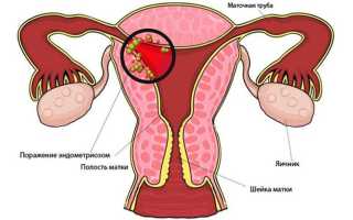 Внутренний эндометриоз: признаки и комплексная терапия