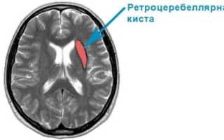 Церебральный вазоспазм