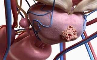 Абсцесс простаты и его последствия для мужчины