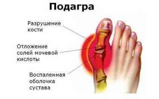 Подагра у мужчин: признаки и лечение в домашних условиях