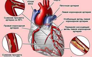 Стенокардия что это такое? Виды, причины, симптомы, что надо и нельзя делать