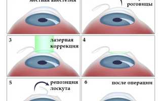 Операция ЛАСИК (LASIK) | Метод лазерной коррекции LASIK