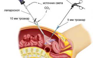 Как делается (проходит) лапароскопия маточных труб