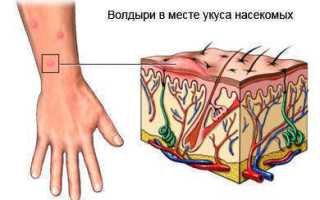 Укусы насекомых: как уберечься от последствий аллергии