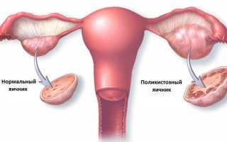 Способы лечения и диагностики поликистоза яичников