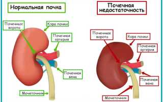 Уколы Прогестерон — инструкция по применению