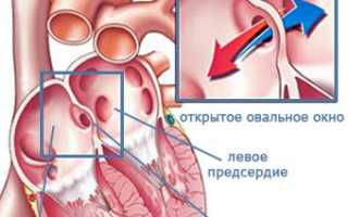 Что нужно знать об открытом овальном окне в сердце ребенка?