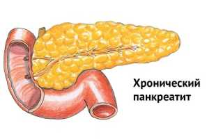 Хронический панкреатит, что это? Симптомы и лечение у взрослых