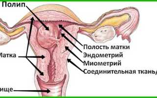 Как удаляют полипы в матке — операция по удалению