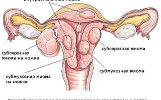 При каких размерах миомы матки делают операцию