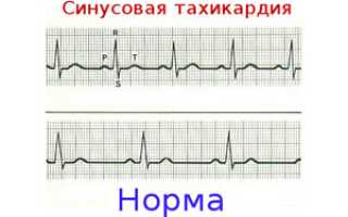 Особенности проявления умеренной тахикардии