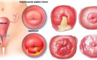 Цервицит шейки матки — симптомы патологии, особенности лечения