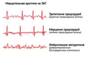 Какие бывают аритмии сердца?