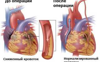Особенности выполнения коронарного шунтирования сердца