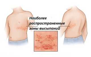 Как вылечить герпес всех видов у детей?