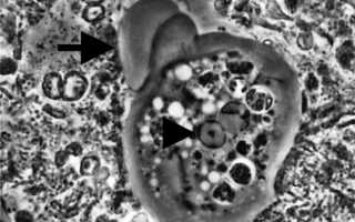 Амеба в ротовой полости, какие заболевания вызывает и как ее лечить