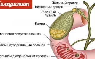 Холецистит симптомы и лечение у взрослых